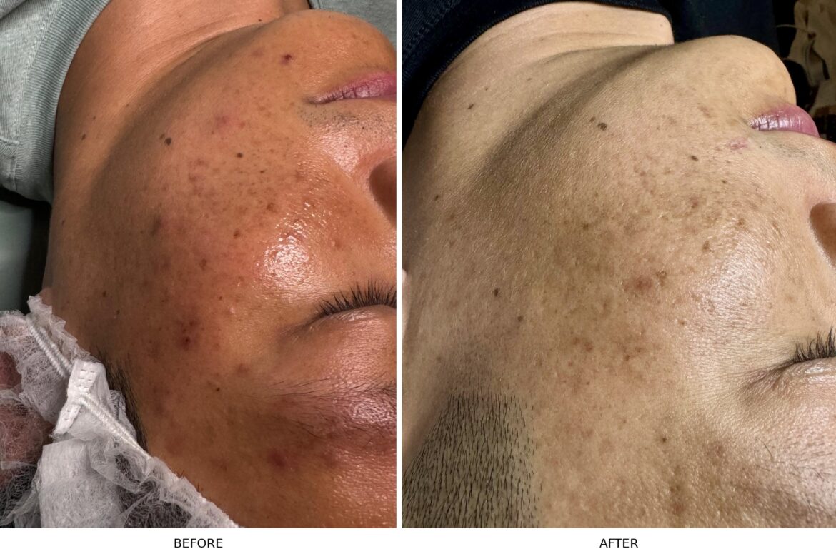 acne_before_after_original_direction-1170x783 